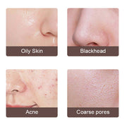 Close-up images showing oily skin, blackheads, acne, and coarse pores targeted by Electric Ultrasonic Skin Scrubber for facial cleansing and skin improvement